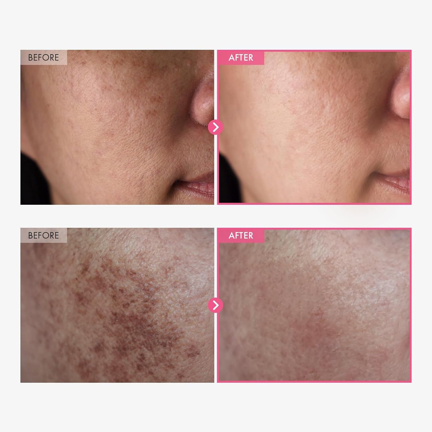 Arbutin 7% + Tranexamic Acid 4% Cream – Targets Dark Spots, Freckles & Pigmentation (50ml)